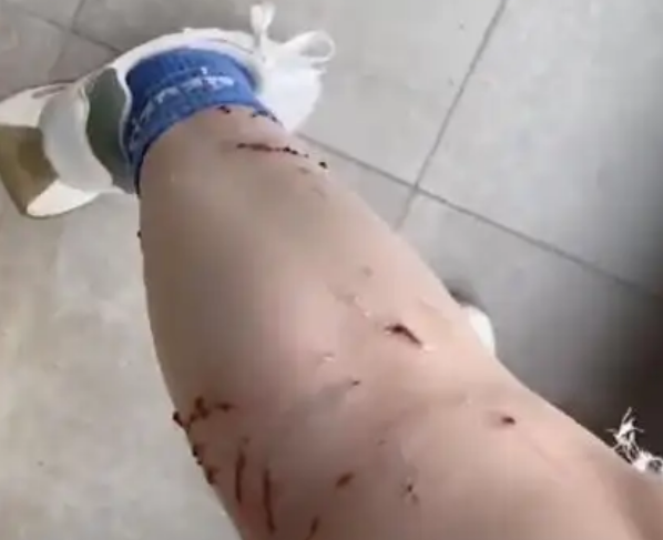 女子被宠物猫咬伤腿部溃烂：打疫苗花1500多元