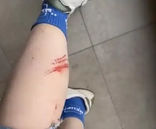 女子被宠物猫咬伤腿部溃烂：打疫苗花1500多元