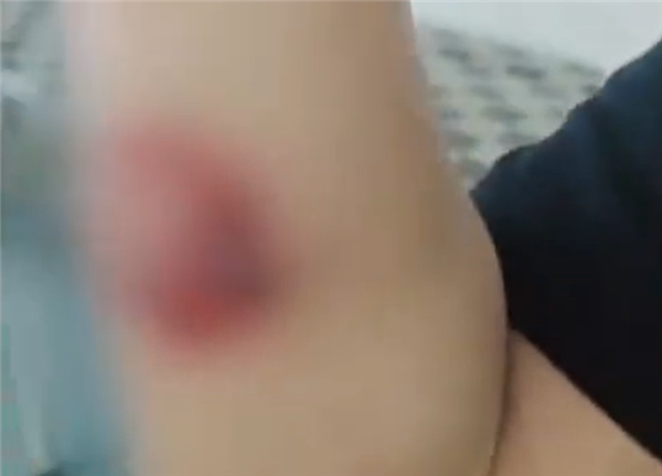 货车司机深夜下车睡觉被狼咬伤：现场恐怖一幕曝光