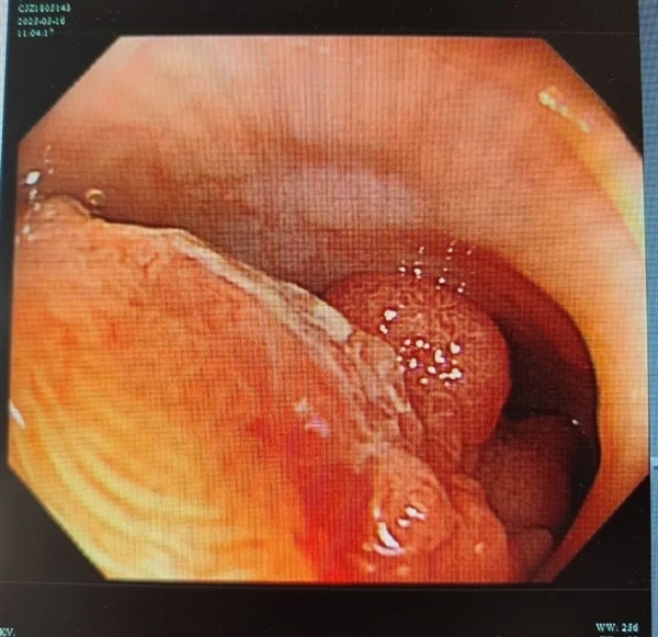 女子体内塞满密密麻麻的“葡萄”！差点拖成癌症