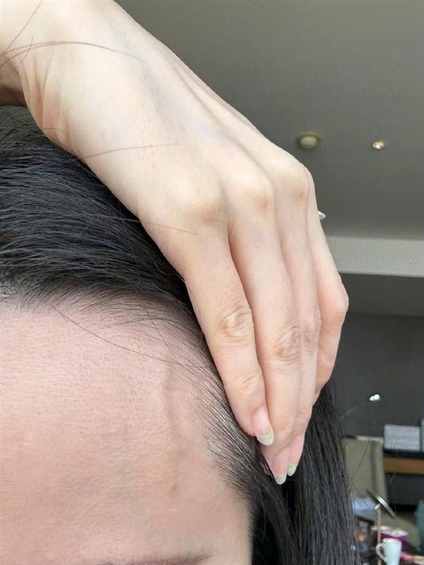 张靓颖自曝体检查出营养不良：额头血管莫名突起 伸懒腰手掌就流血