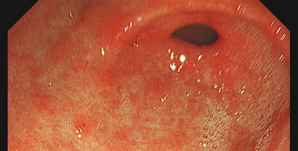 2个人中就有1人感染：医生让查幽门螺旋杆菌是真的想救你！