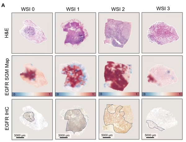 大突破！腾讯AI可预测肺癌基因突变：准确率99%