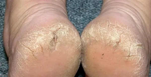 脚后跟总开裂起皮 不一定是干燥造成的！小心这几种病