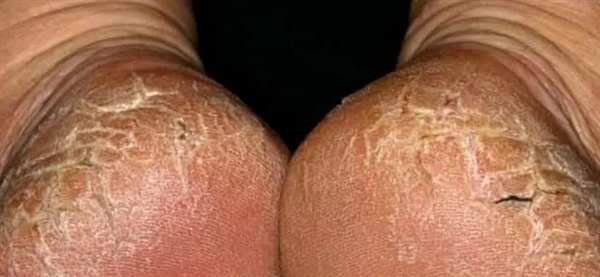 脚后跟总开裂起皮 不一定是干燥造成的！小心这几种病