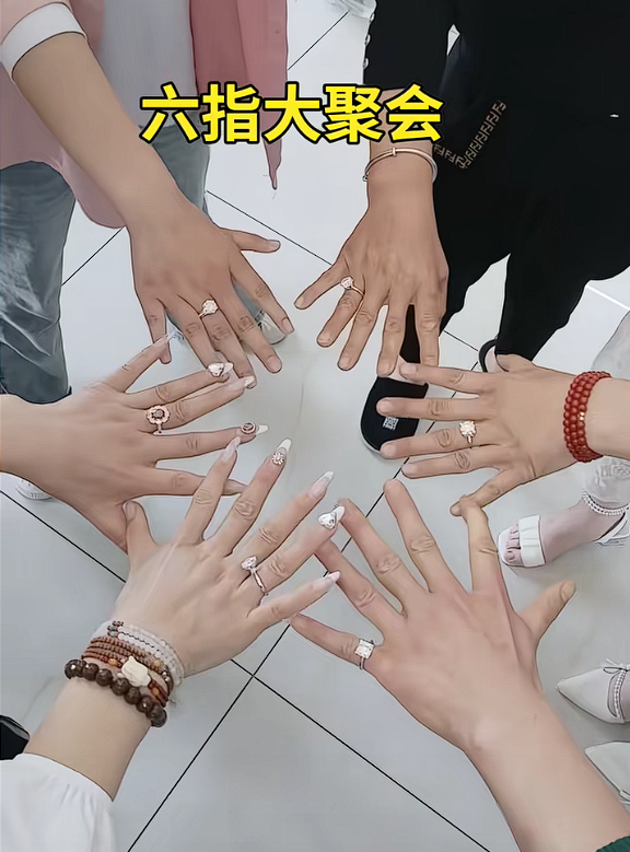 女子长12根手指自称灵活好用：吸粉超百万成大网红